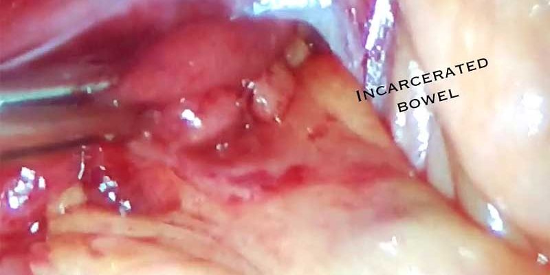 What is incarcerated bowel What is incarcerated bowel? by Dr. Iraniha
