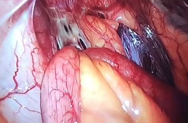 What is internal hernia What is internal hernia by Dr. Iraniha