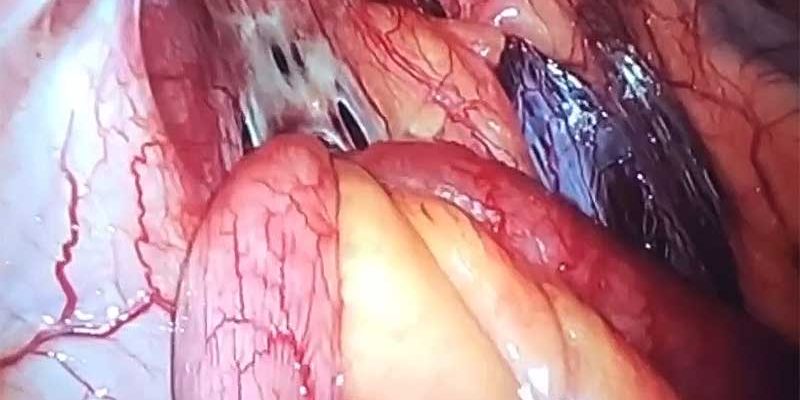 What is internal hernia What is internal hernia by Dr. Iraniha