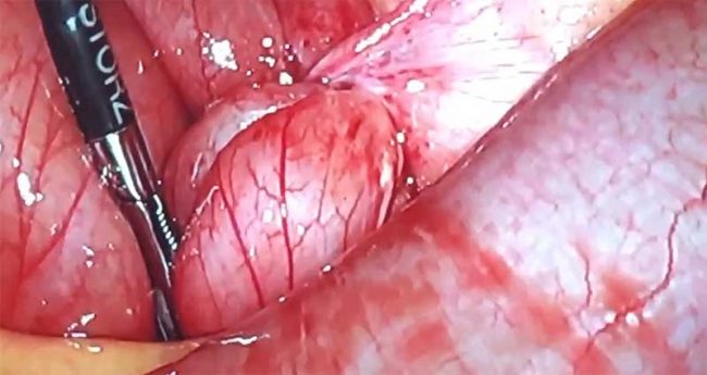 What is the adhesion band What is the adhesion band by Dr. Iraniha