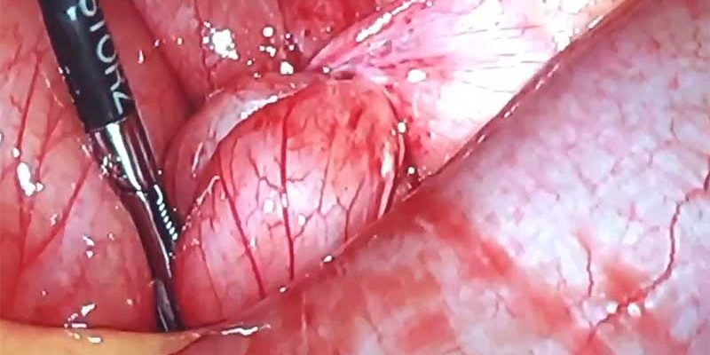 What is the adhesion band by Dr. Iraniha