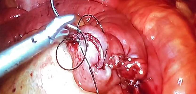 Dr. Iraniha Small bowel resection laparoscopy surgery - Surgical Oasis Institute