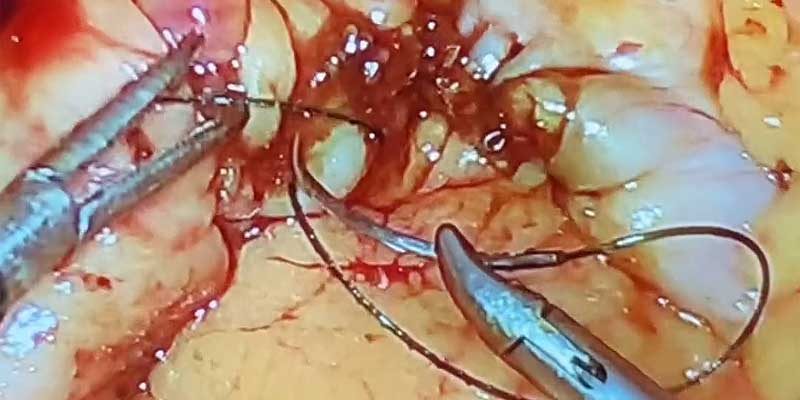 Dr. Iraniha laparoscopic resection surgery of the right colon with primary anastomosis Dr. Iraniha laparoscopic resection surgery of the right colon with primary anastomosis - Surgical Oasis Institute