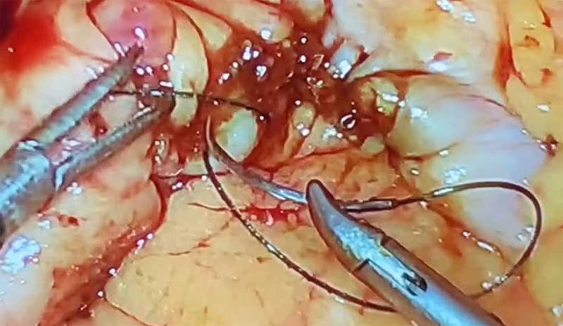 Dr. Iraniha laparoscopic resection surgery of the right colon with primary anastomosis - Surgical Oasis Institute