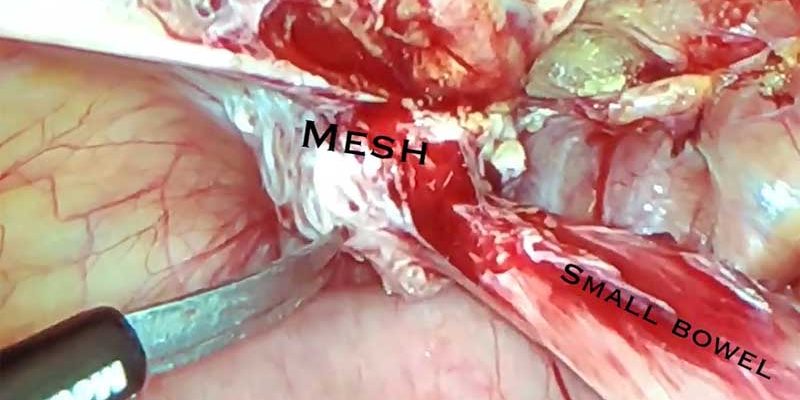 What is the bowel adhesion to surgical mesh