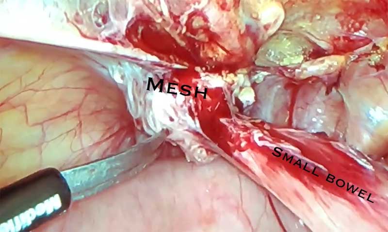 What is the bowel adhesion to surgical mesh by Dr. Iraniha
