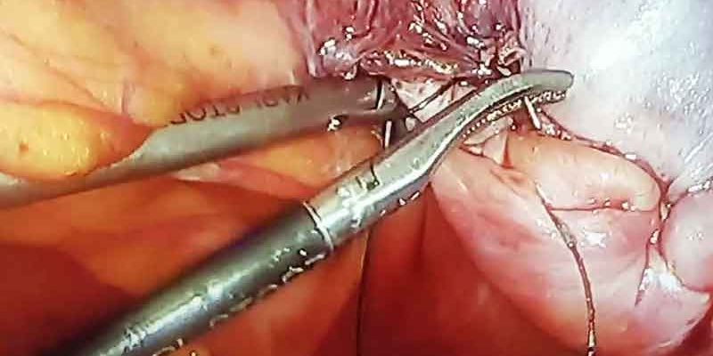 Laparoscopic repair of giant inguinal hernia by Dr. Iraniha