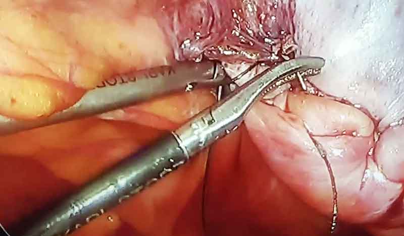 Laparoscopic repair of giant inguinal hernia by Dr. Iraniha