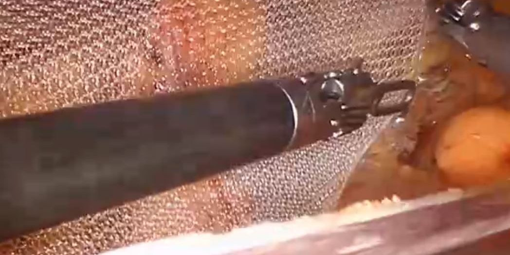 Dr Iraniha Robotic assisted bilateral inguinal hernia repair with mesh Dr Iraniha Robotic assisted bilateral inguinal hernia repair with mesh - Surgical Oasis Institute