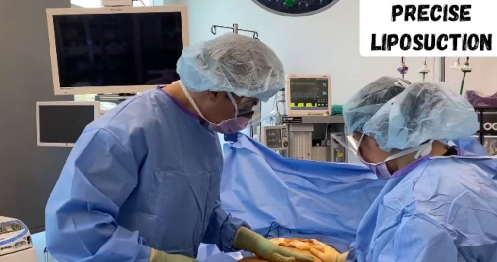 What is Liposuction or Lipo Sculpture by Dr. Iraniha