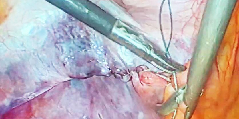 Dr. Iraniha Laparoscopic bilateral inguinal hernia repair - Surgical Oasis Institute