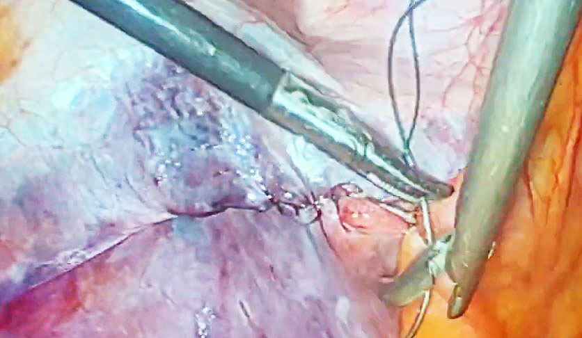 Dr. Iraniha Laparoscopic bilateral inguinal hernia repair - Surgical Oasis Institute