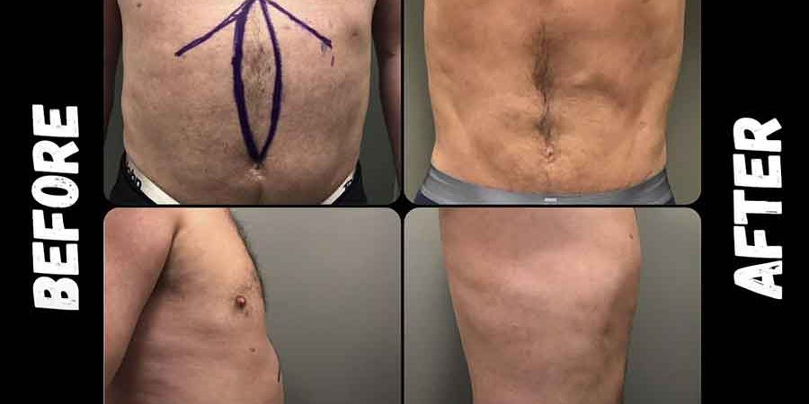 Dr Iraniha Redo Mini Tummy Tuck and Excision of Pseudo Bursa Dr Iraniha Redo Mini Tummy Tuck and Excision of Pseudo Bursa - Surgical Oasis Institute