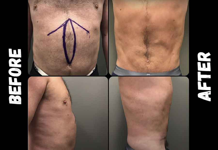 Dr Iraniha Redo Mini Tummy Tuck and Excision of Pseudo Bursa - Surgical Oasis Institute