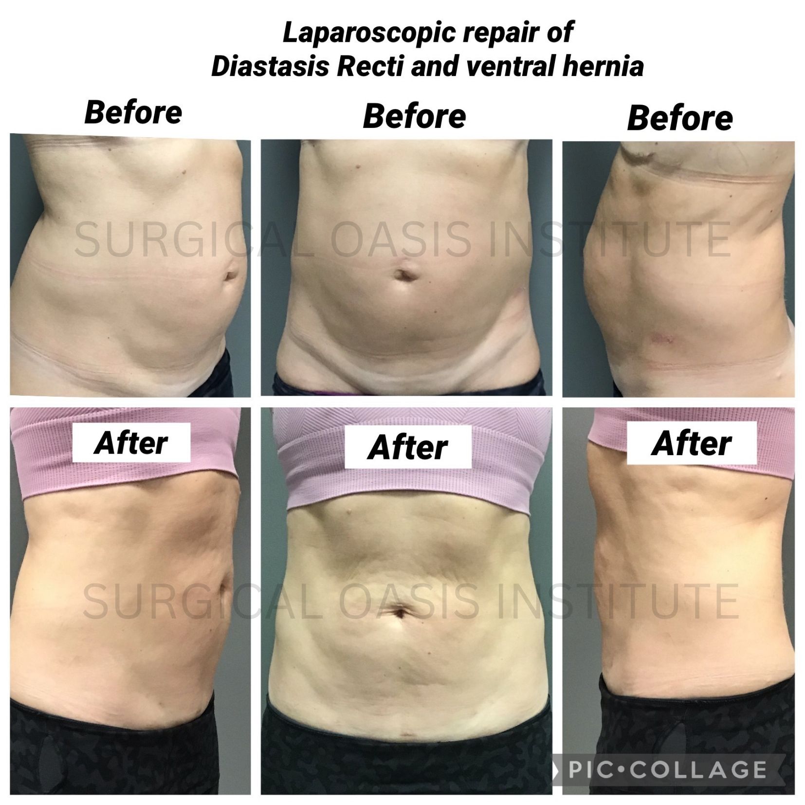 Orange County Laparoscopy Surgery Before and After Surgery Pictures