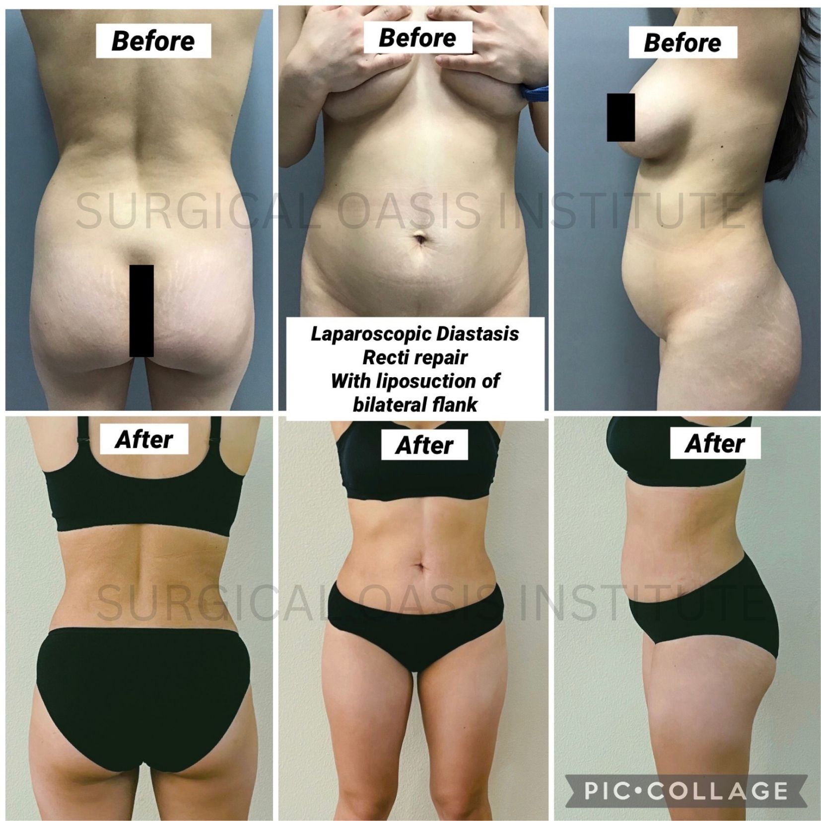 Orange County Diastasis Recti Repair