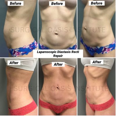 Dr. Iraniha Laparoscopic Diastasis Recti Repair Dr. Iraniha Laparoscopic Diastasis Recti repair