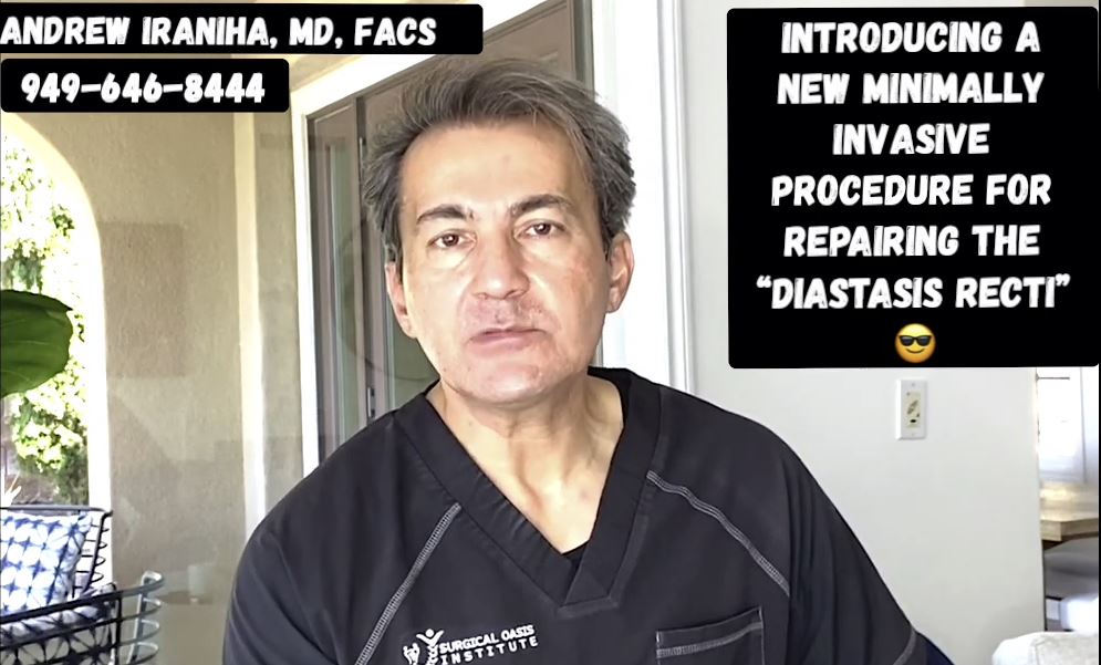 Dr Iraniha New Minimally Invasive Procedure to Repair Diastasis Recti - SOI