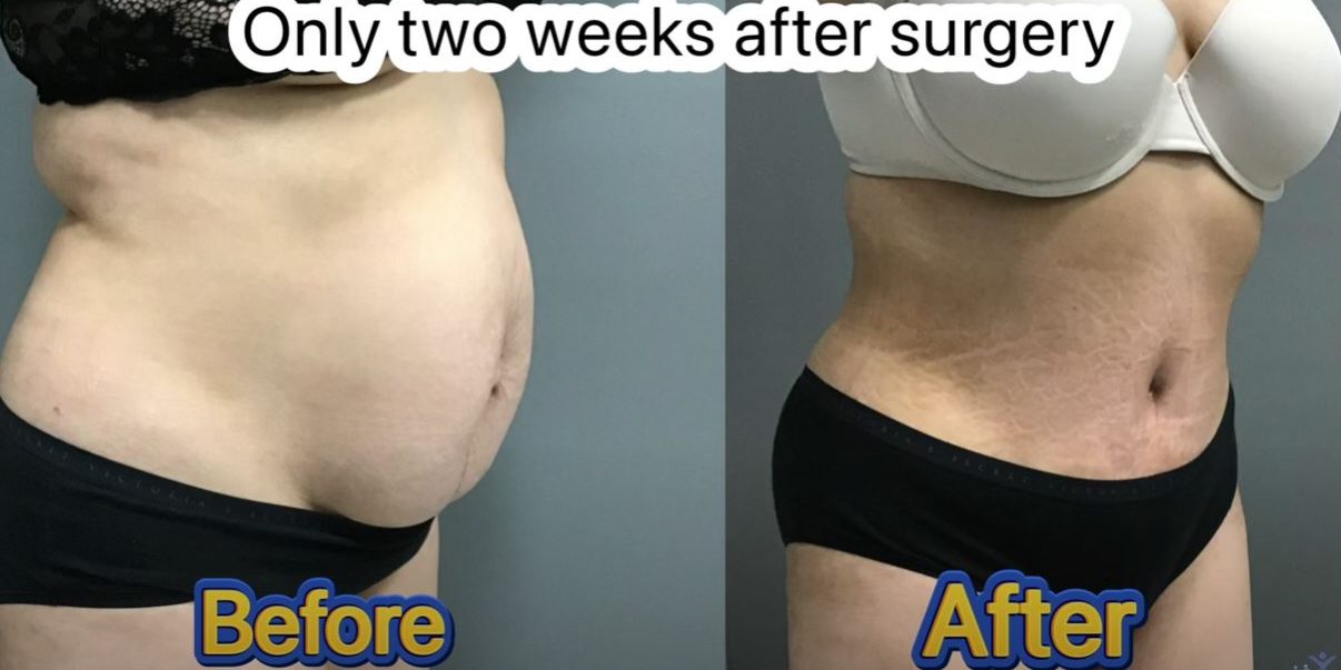 Innovative approach for Hernia Repair with a Tummy Tuck Surgery by Dr. Iraniha