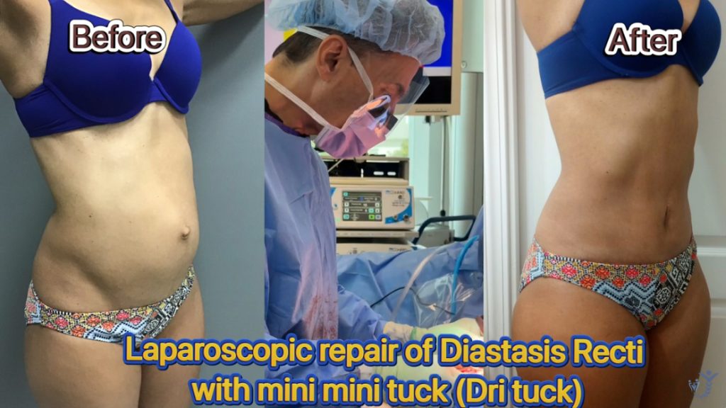 New Minimally Invasive Surgery to Repair the Diastasis Recti by Dr. Iraniha
