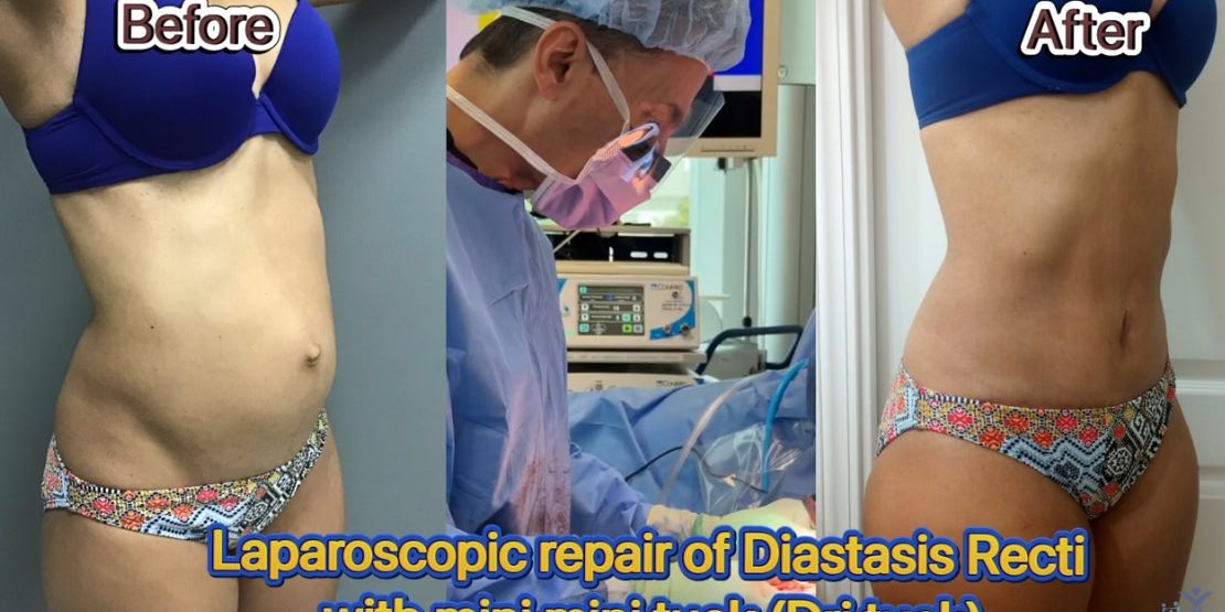 New Minimally Invasive Surgery to Repair the Diastasis Recti by Dr. Iraniha