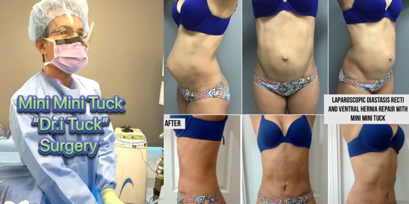 Mini Mini Tuck Surgery Dri Tuck by Dr. Iraniha