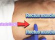 What can happen if you leave Diastasis Recti untreated - By Dr. Iraniha