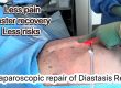 Repairing The Diastasis Recti in Men by Dr. Iraniha