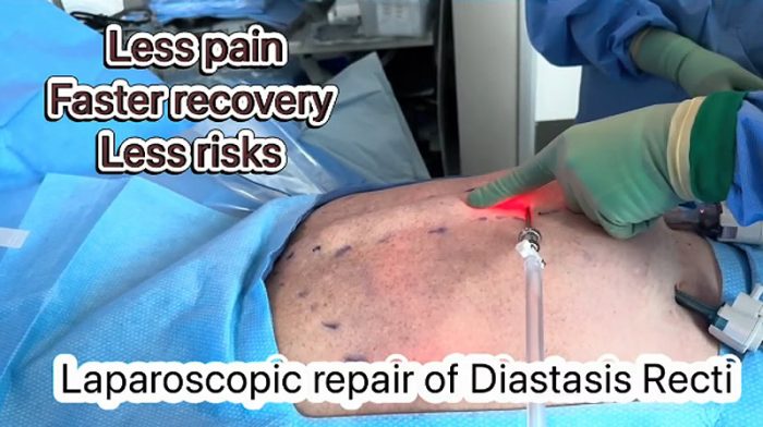 Repairing The Diastasis Recti in Men by Dr. Iraniha