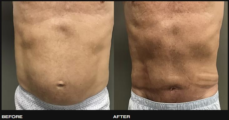 Cosmetic Procedure for Men Laparoscopic Diastasis Recti Repair by Dr. Iraniha