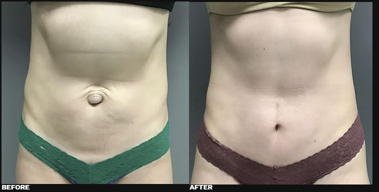 DIASTASI RECTI REPAIR 1