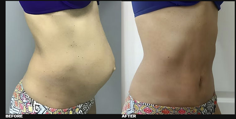 DIASTASI RECTI REPAIR 2