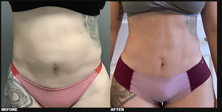 DIASTASI RECTI REPAIR 3