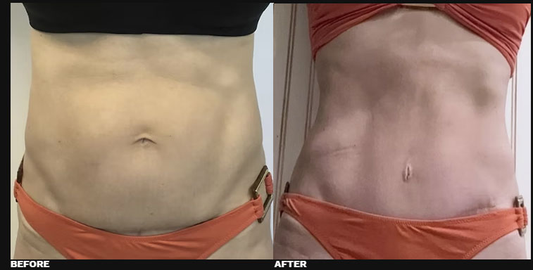 DIASTASI RECTI REPAIR 4