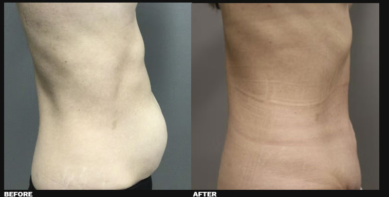 DIASTASI RECTI REPAIR 5