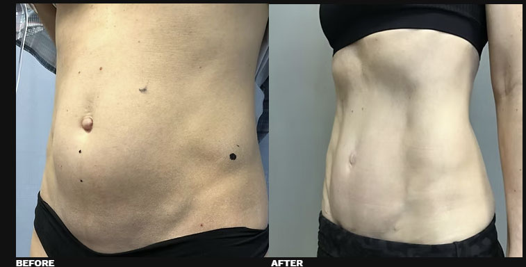 DIASTASI RECTI REPAIR 6