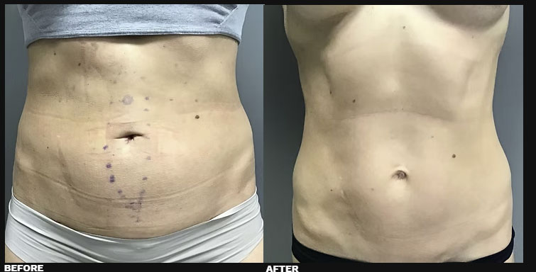 DIASTASI RECTI REPAIR 7