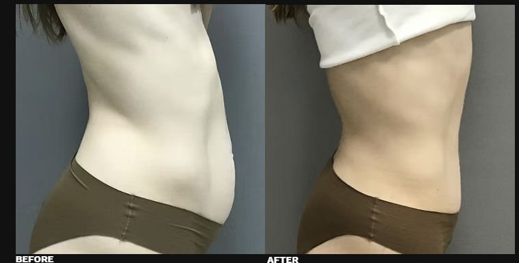 DIASTASI RECTI REPAIR 8