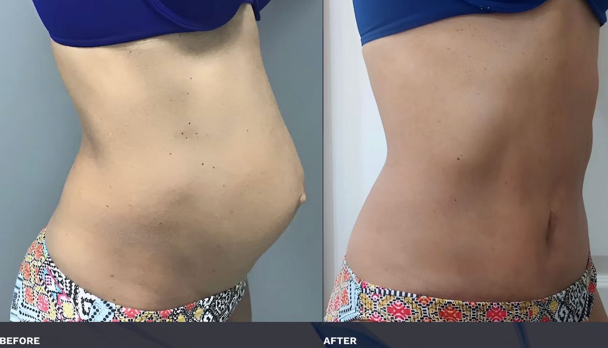 Diastasis Recti Repair Before and After
