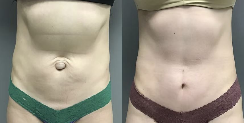 Dr-Iraniha-Hernia-Surgery Dr. Iraniha Hernia Surgery