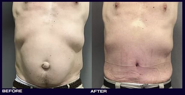 Tummy Tuck Cosmetic Procedure for Men by Dr. Iraniha