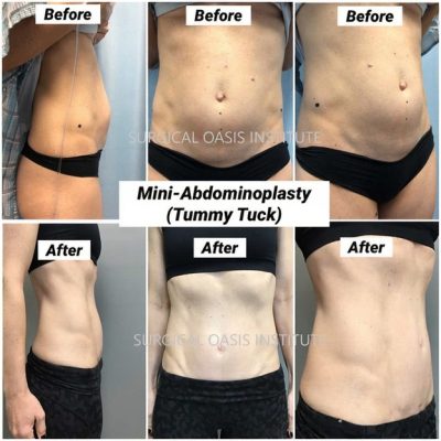 Dr Iraniha Mini Tummy Tuck Surgery Dr Iraniha Mini Tummy Tuck Surgery