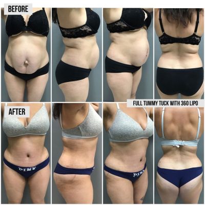 Dr-Iraniha-Tummy-Tuck-with-Liposuction Dr Iraniha Tummy Tuck with Liposuction Surgery