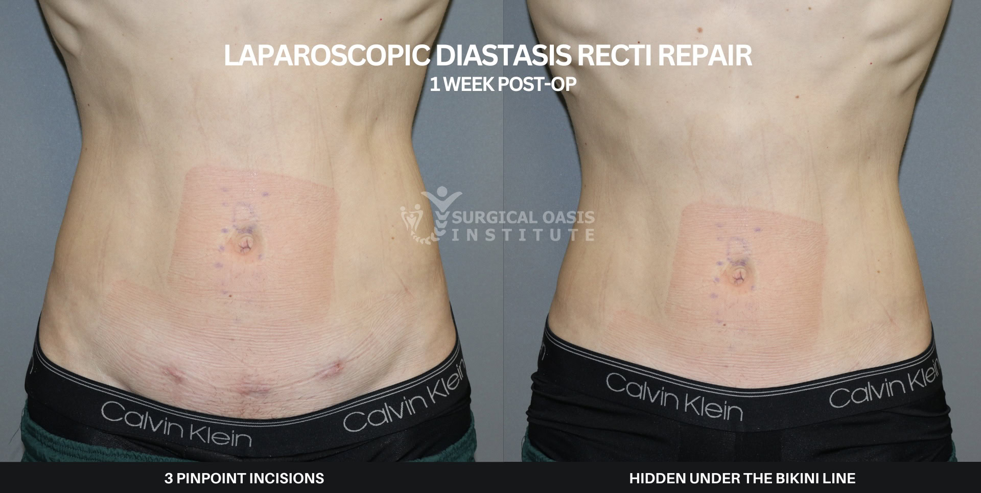 Dr. Iraniha - Diastasis Recti Repair - 3 pinpoint incisions