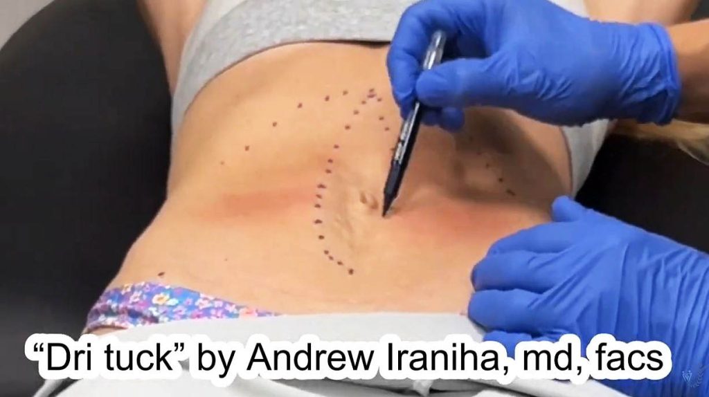 DRI Tuck vs Traditional Tummy Tuck - Dr. Iraniha