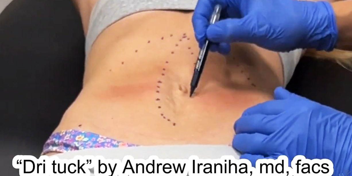 DRI Tuck vs Traditional Tummy Tuck - Dr. Iraniha